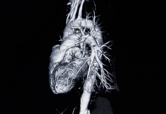 Cardiovascular_Heart