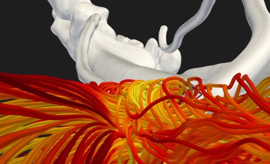 DeviceInformatics ApproachesVideo AI and aeronautic models used to optimise blood flow and improve haemodialysis