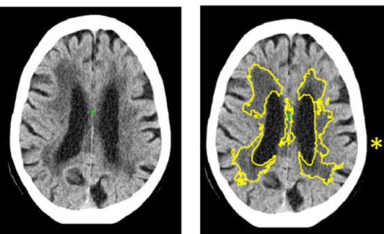 DiagnosticInformatics Approaches Artificial Intelligence (AI) improves stroke and dementia diagnosis in brain scans