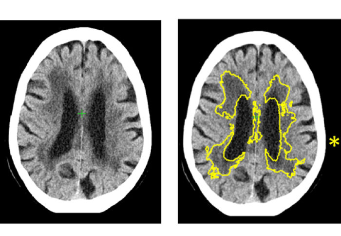 Artificial Intelligence (AI) improves stroke and dementia in brain scans – NIHR Research Centre