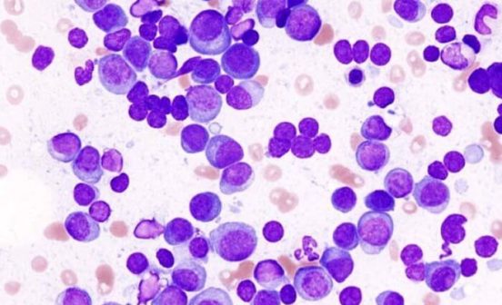 First in HumanTherapeutic Novel promising treatment strategy for multiple myeloma