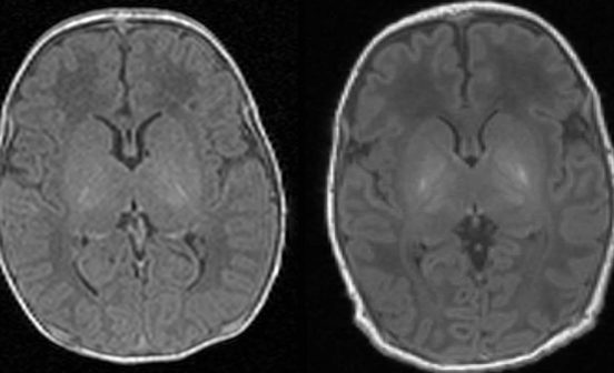 DiagnosticInnovationPrevention A 15-minute scan could help diagnose brain damage in newborns