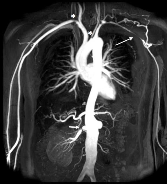 Vasculitis