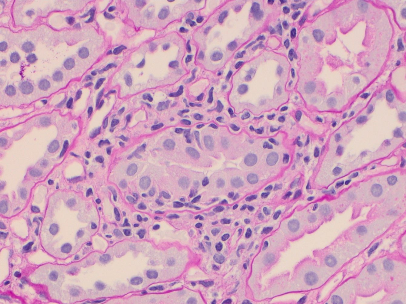 Update To Kidney Biopsy Classification System Nihr Imperial