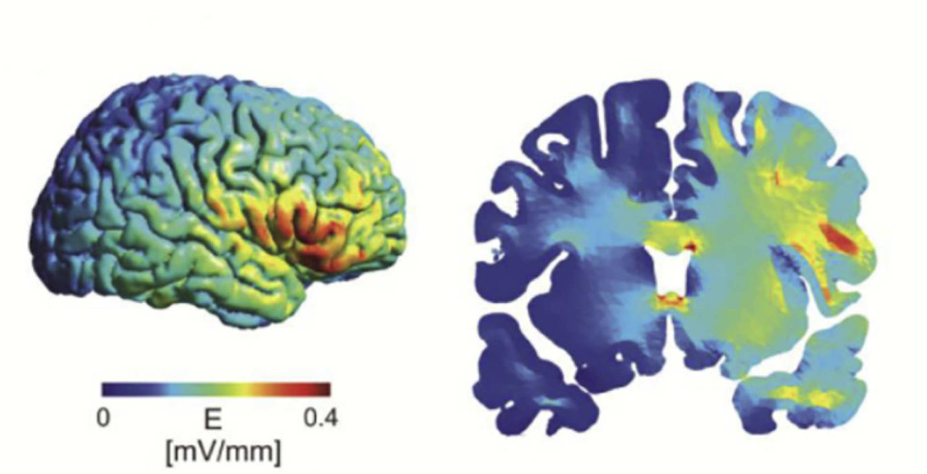 modelling of electric current over frontal lobe