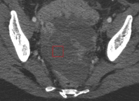 Machine Learning Ovarian Cancer