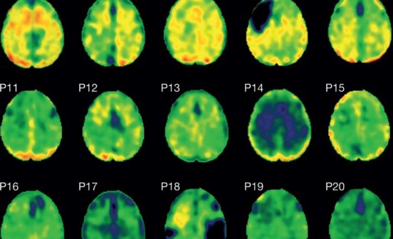 DiagnosticFirst in Human Protein tangles linked with dementia seen after single head injury