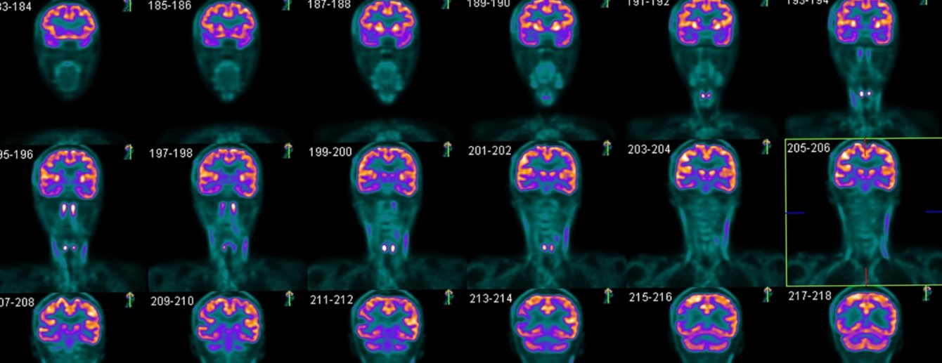 brain-pet-scan-2x