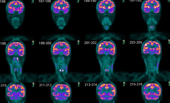 Diagnostic Brain imaging tool falls short for human tissue