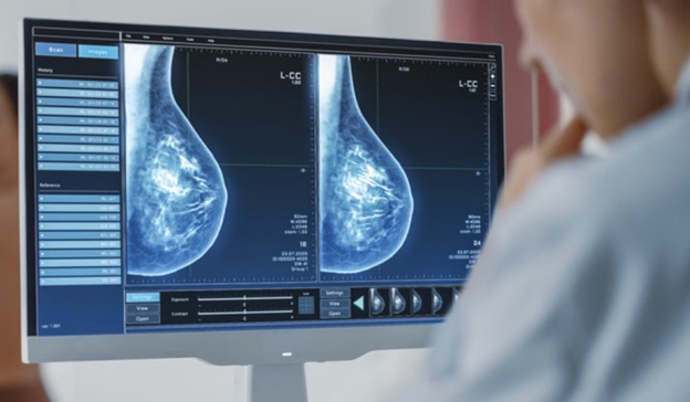 AI breast cancer