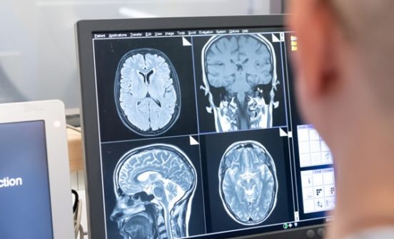 DiagnosticInnovationPrevention Single brain scan can diagnose Alzheimer’s disease