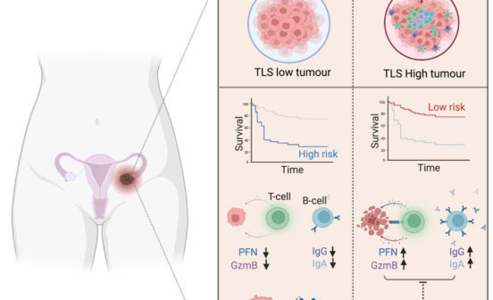 Graphical abstract of Ovarian Cancer diagnosis